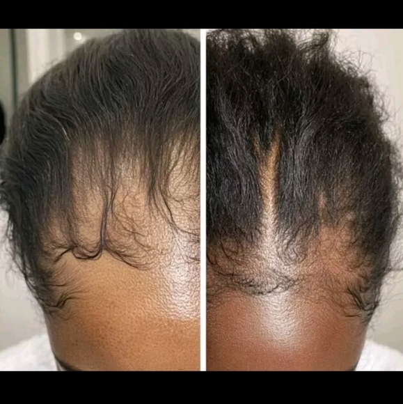 *:New Crown naturale Electric Scalp Massager Hair Oil Applicator Brush Red Light - Picture 10 of 16